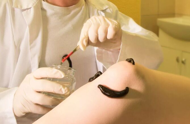 Hirudotherapy for varicose veins