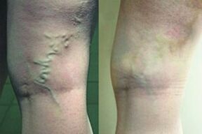 Varicose veins on the legs