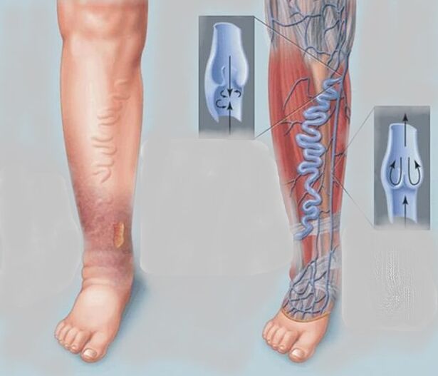 Varicose veins on the legs