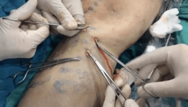 How is phlebetomy performed to remove varicose veins